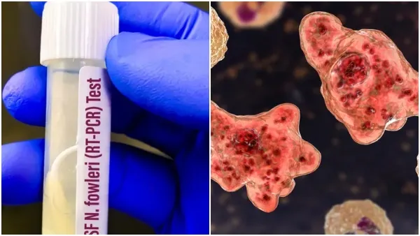 டெக்சாஸில் மூளையை தின்னும் அமீபா : 5 நாட்களில் மரணம்!